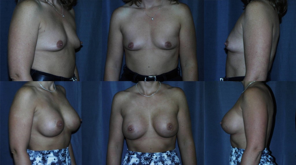 breast lift without implants. Tubular Breast Augmentation