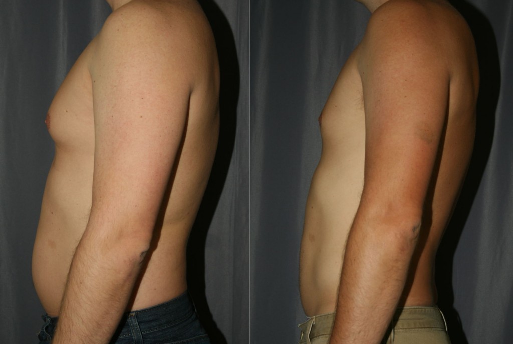 gynecomastia surgery before after. Before (Left) shows localized