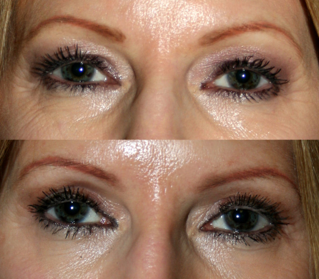 What can you do to lessen scars after blepharoplasty?