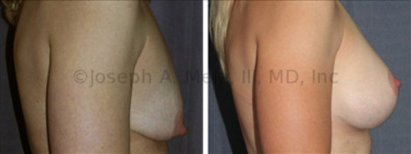 Breast Enhancement is half of the Mommy Makeover. In this case, a Breast Augmentation Mastopexy is performed. A Breast Implant is used to increase the breast volume, while a Breast Lift is used to raise the nipple and reshape the breast. A larger implant without a lift would not make a pretty breast. A larger implant would make larger breasts, too large for this patient's desires. Additionally, the larger implant would push the nipple lower on the breast.