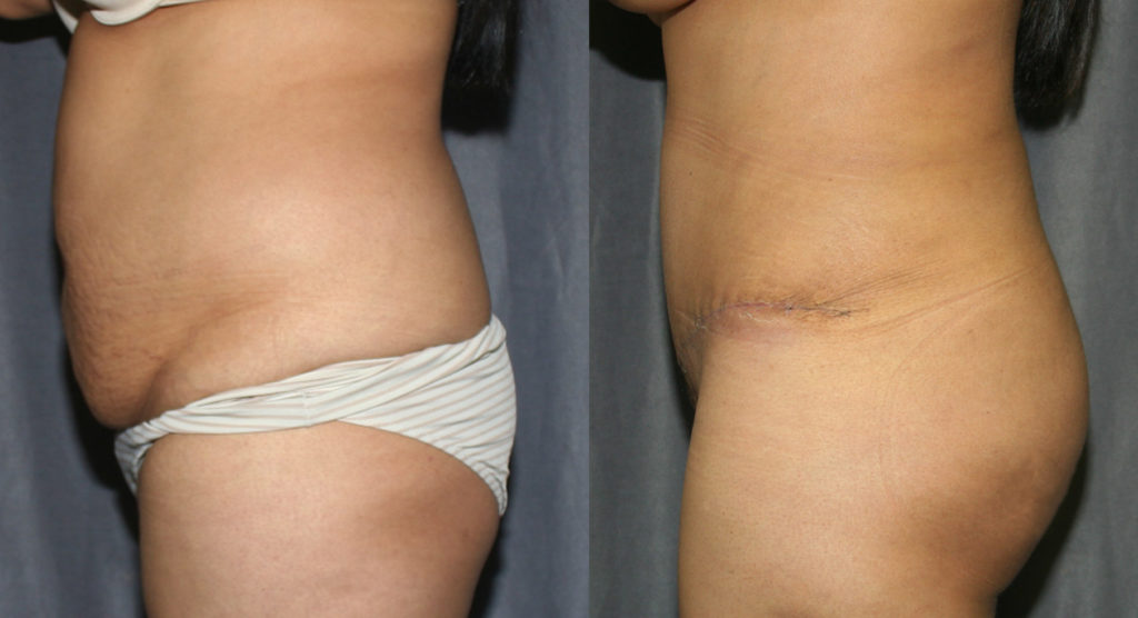 Tummy Tuck and Brazilian Butt Lift Before and After Pictures: In this case, Abdominoplasty is combined with Liposuction of the back and flanks. The fat is harvested and grafted into the buttocks to create fuller, curvier buttocks.