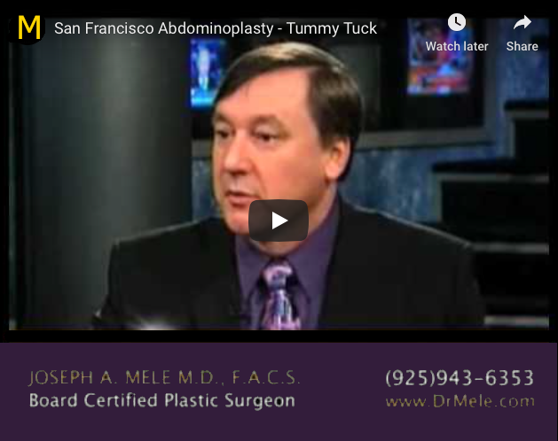 Tummy Tuck and Alternatives Video Presentation with before and after pictures