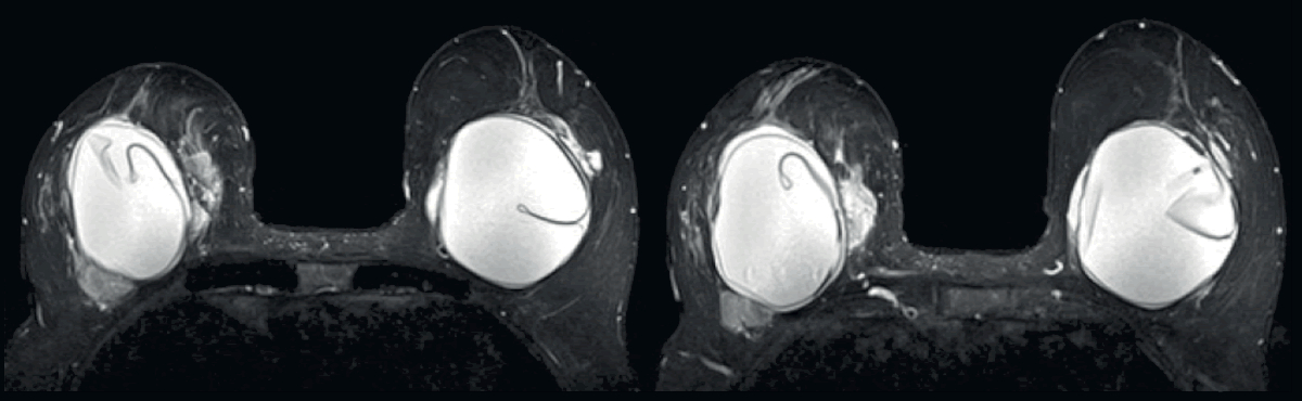 Capsular contracture on MRI with rupture and silicone extravasation.