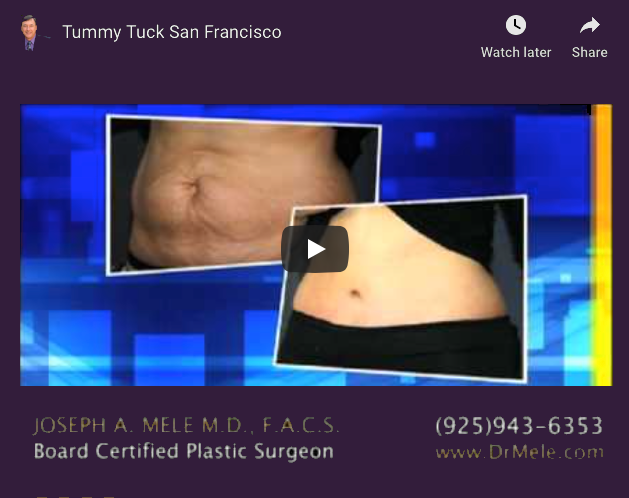 Mommy Makeover Tummy Tuck and Mini Tummy Tuck Video Presentation with before and after photos