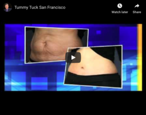 TUmmy tuck, mini tummy tuck abd liposuction video presentation with before and after pictures