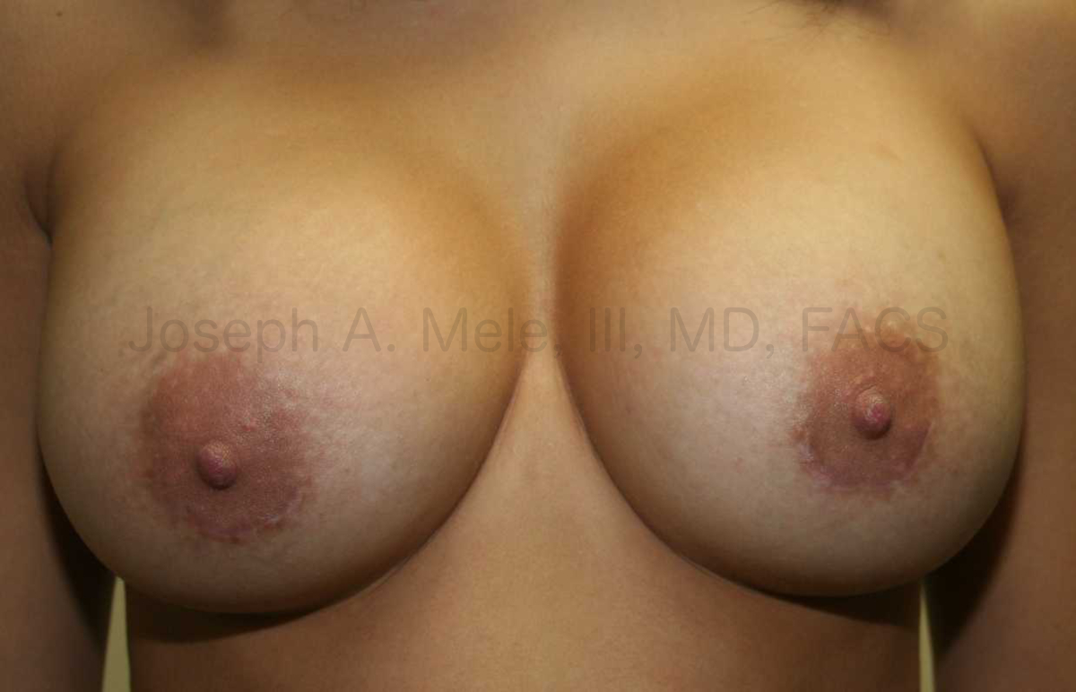 After scar revision the periareolar scars are thin, fine and follow the natural contours.
