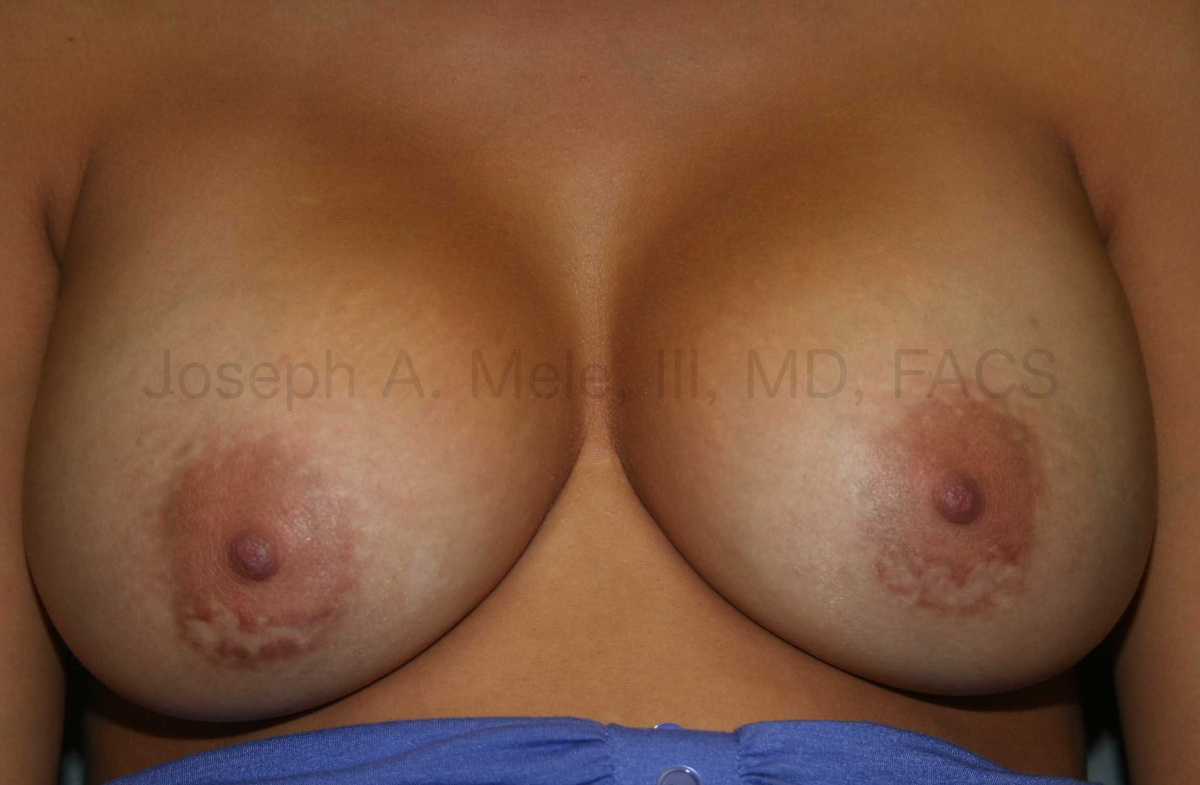 Wide spread periareolar scars below the nipples after breast augmentaion.