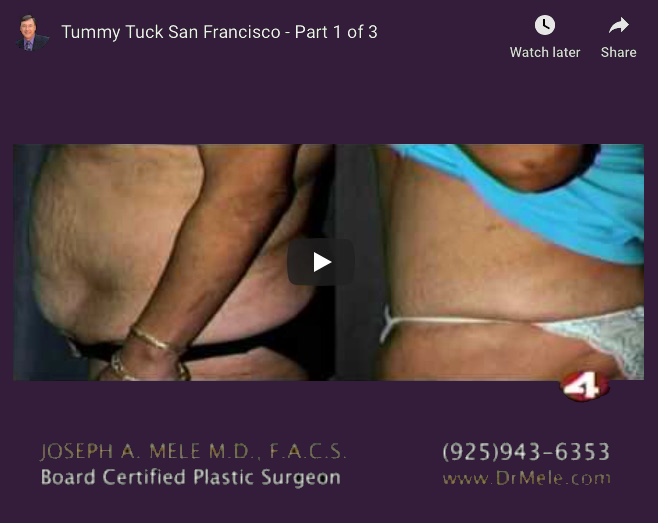 Tummy Tuck Video Presentation with abdominoplasty before and after pictures