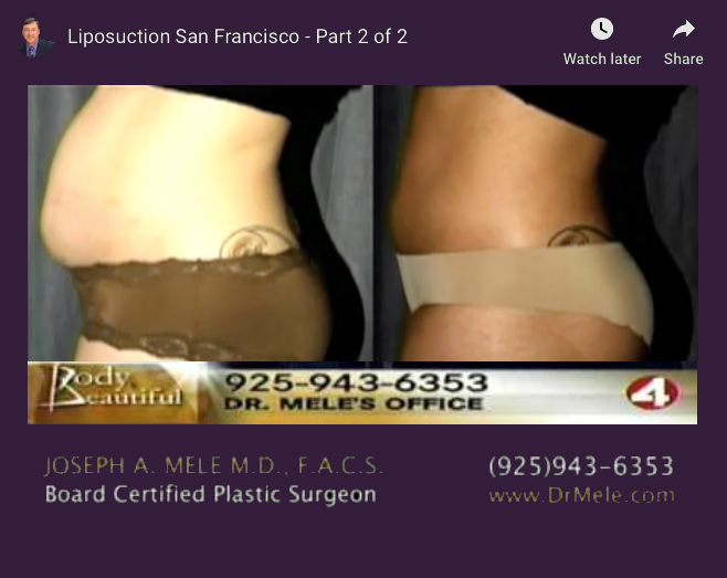 Tumescent Liposuction Video Presentation with before and after pictures