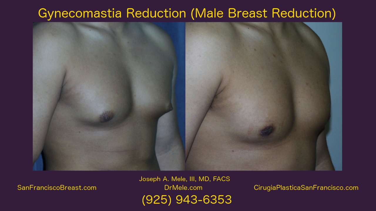 Gynecomastia Reduction Before and After Pictures Video (Male Breast Reduction)