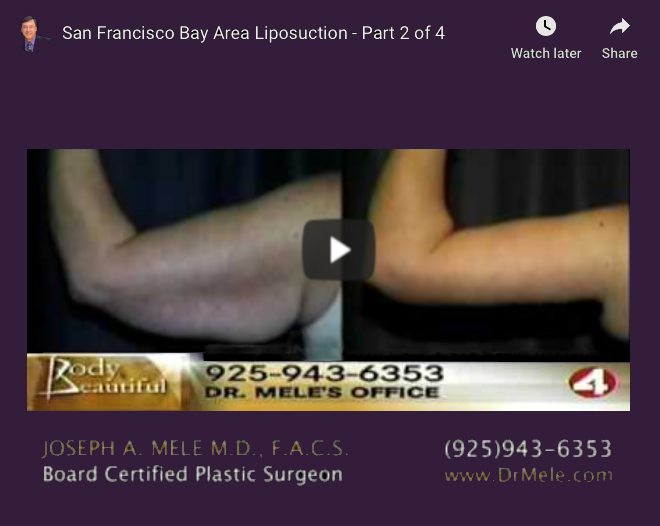 Liposuction Video Presentation with before and after pictures
