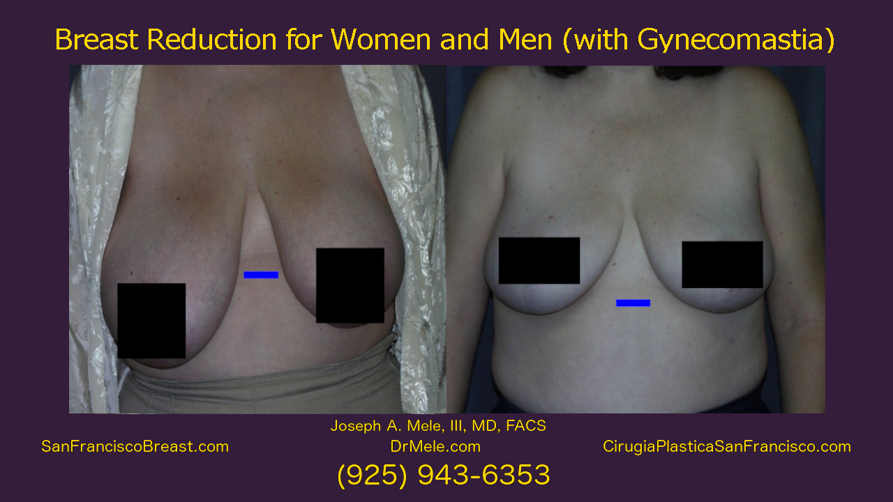 Breast Reduction Video Presentation with reduction mammoplasty before and after pictures