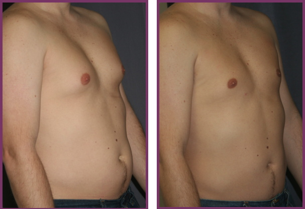 Gynecomastia Reduction Before and After Pictures (Male Breast Reduction)