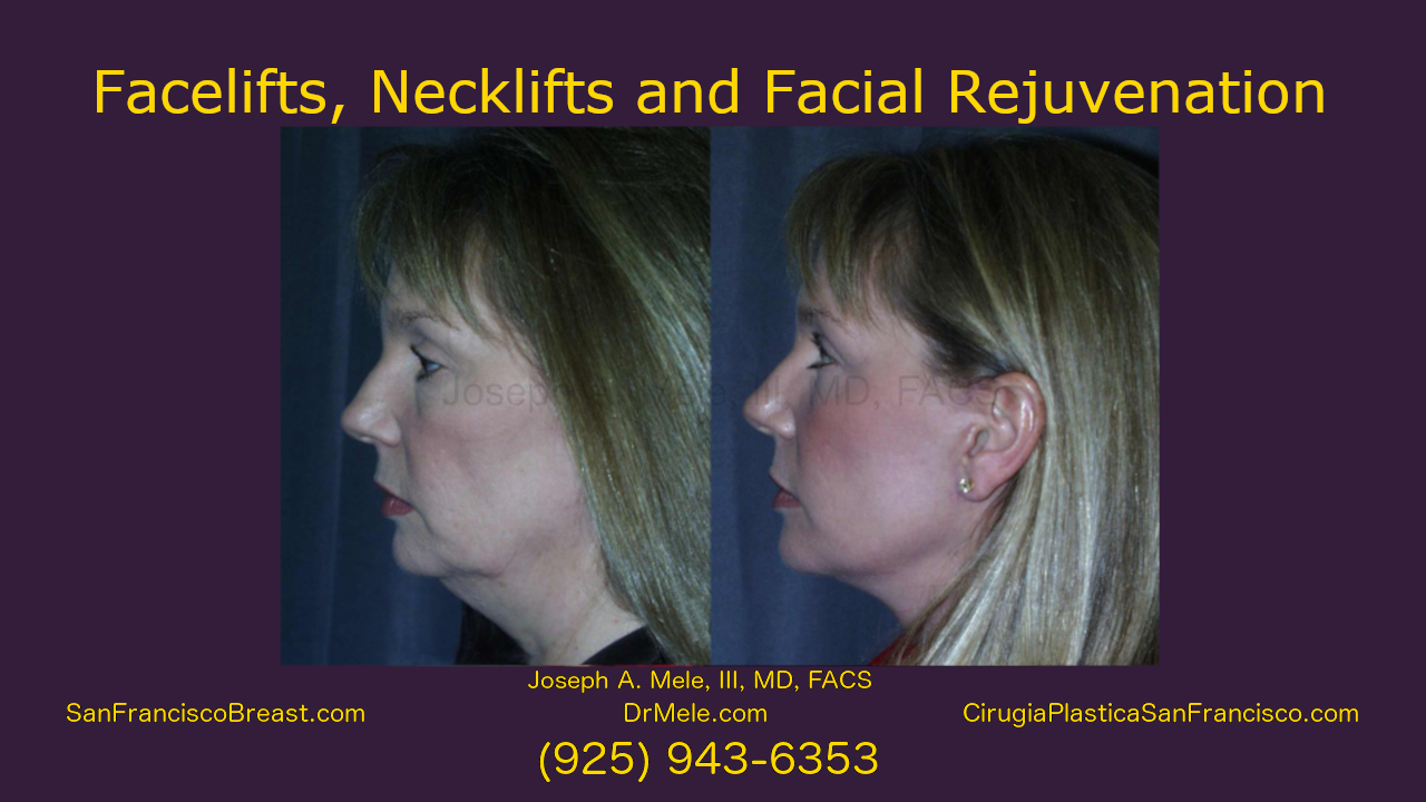 facelift, neck lift facial rejuvenation video with rhytidectomy before and after pictures
