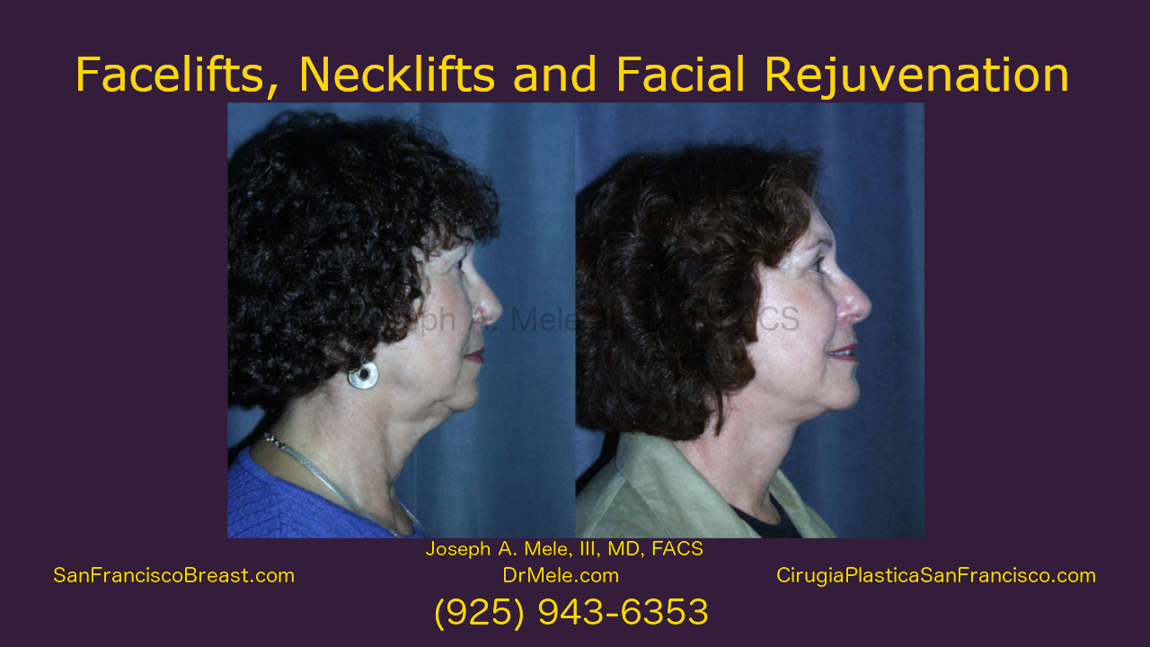 facelift, neck lift facial rejuvenation video with rhytidectomy before and after pictures