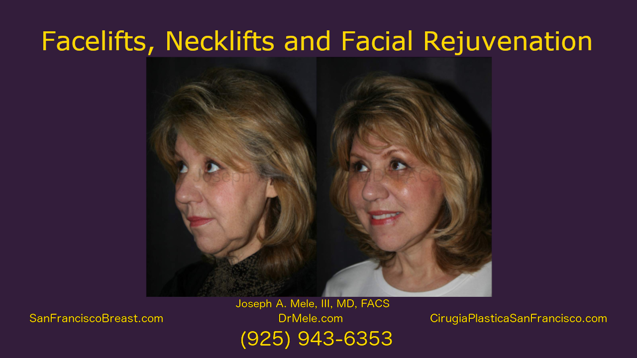 facelift, neck lift facial rejuvenation video with rhytidectomy before and after pictures