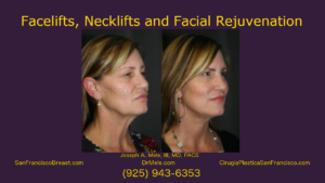facelift, neck lift facial rejuvenation video with rhytidectomy before and after pictures