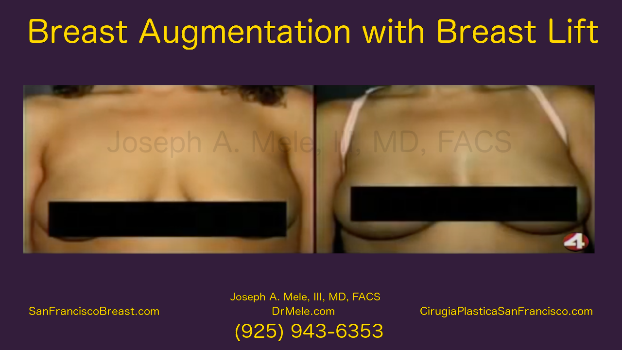 Breast Augmentation Lifts Video with Before and After Pictures