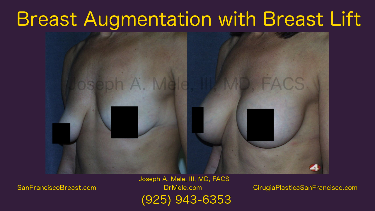 Breast Augmentation Lifts Video with Before and After Pictures