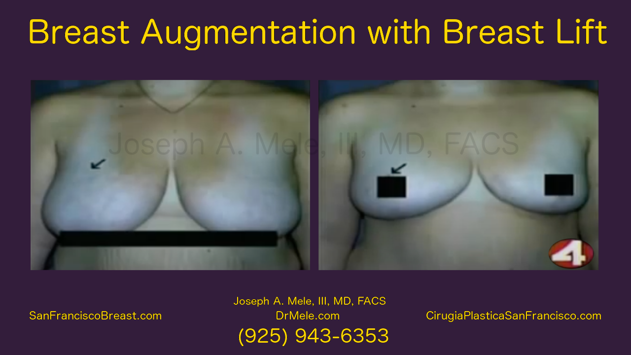 Breast Augmentation Lifts Video with Before and After Pictures