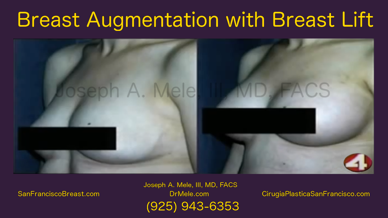 Breast Augmentation Lifts Video with Before and After Pictures