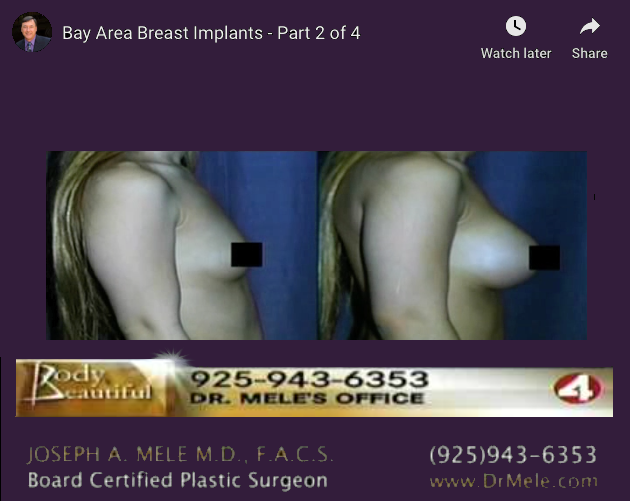 Breast Augmentation Video Presentation