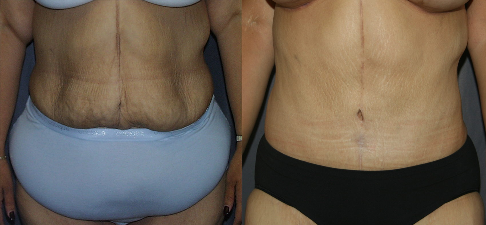 Fleur De Lis Tummy Tuck - Post-Bariatric Plastic Surgery