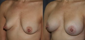 Tubular Breast Augmentation Lift
