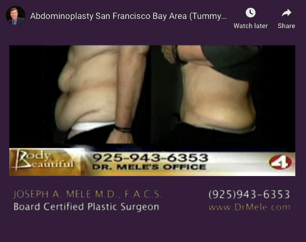 Tummy Tuck Video Presentation (Abdominoplasty) with before and after pictures