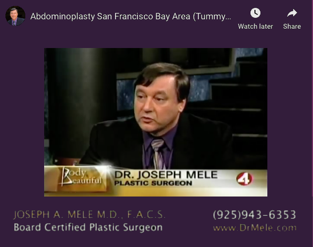 Abdominoplasty (Tummy Tuck) Video Presentation
