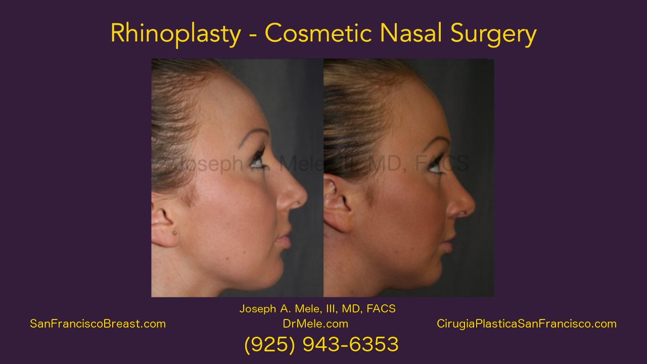 Rhinoplasty Video presentation with cosmetic nasal surgery before and after pictures