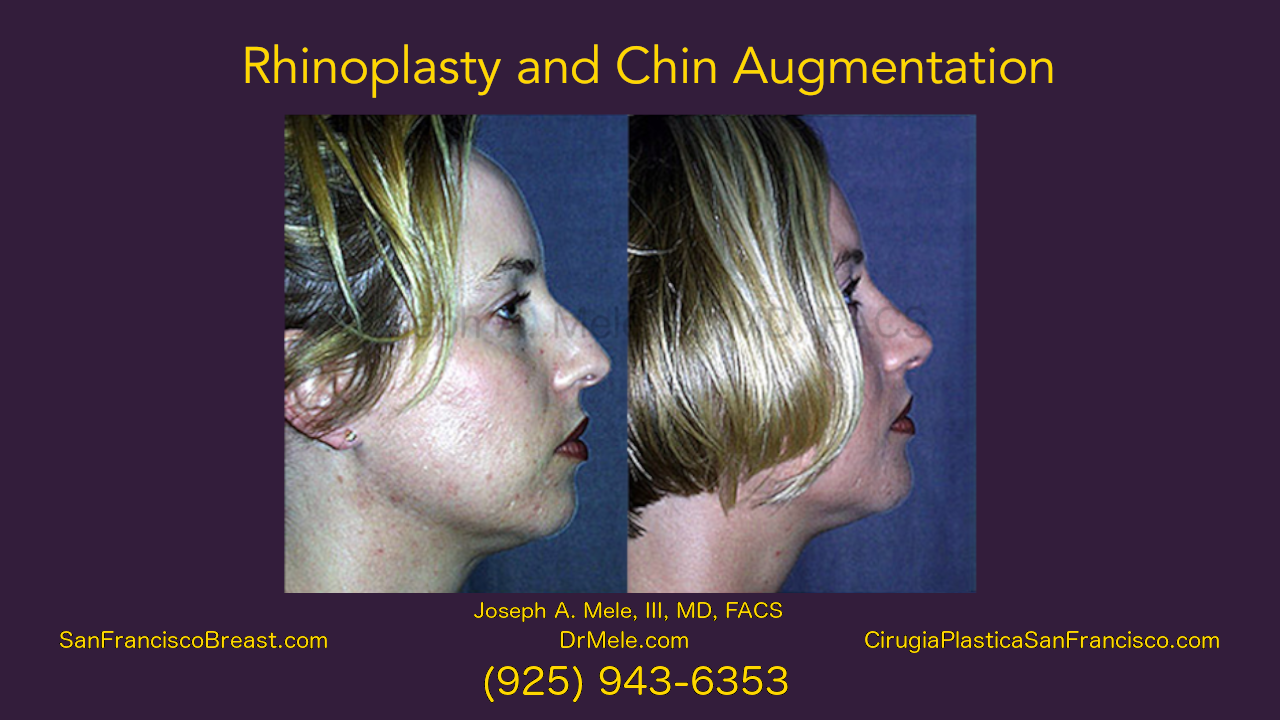 Rhinoplasty and Chin Augmentation Video Presentation with before and after photos
