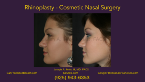 Rhinoplasty Video presentation with cosmetic nasal surgery before and after pictures