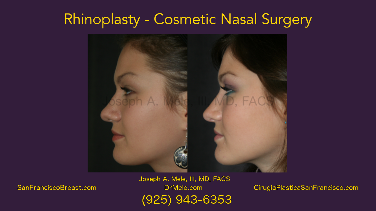 Rhinoplasty Video presentation with cosmetic nasal surgery before and after pictures