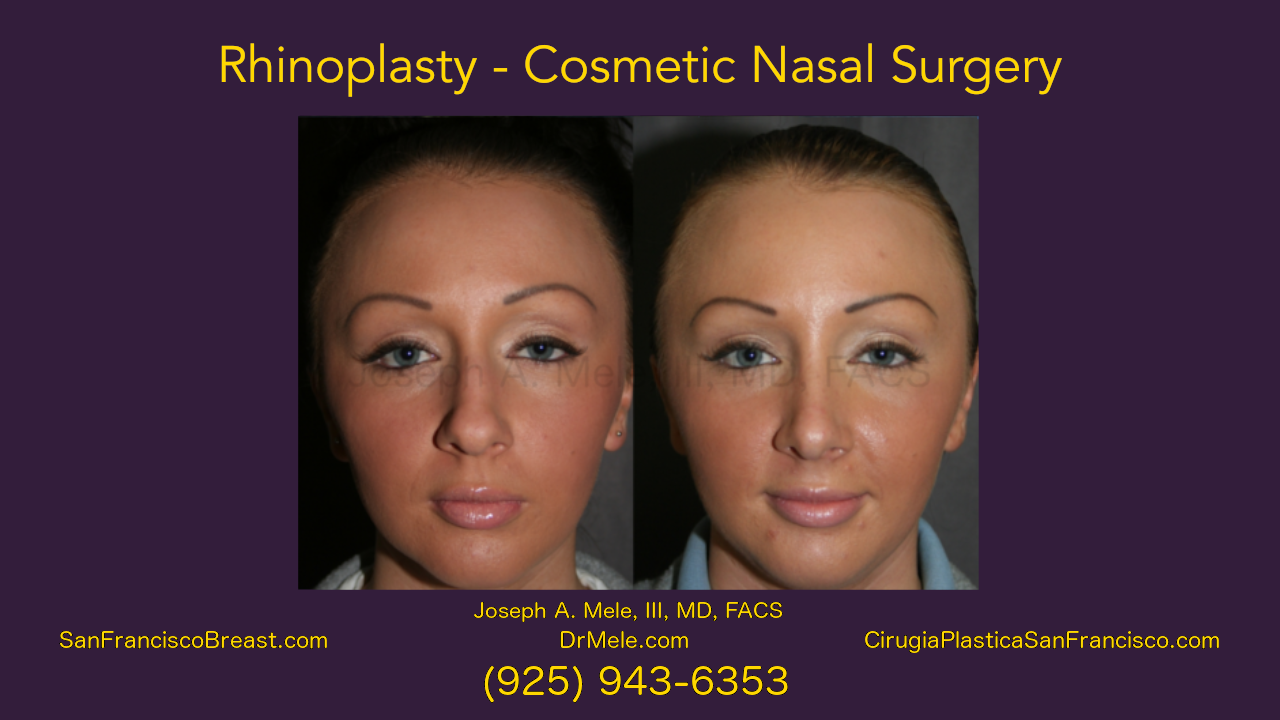 Rhinoplasty Video presentation with cosmetic nasal surgery before and after pictures