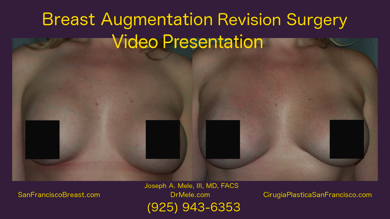 Breast Augmentation Revision before and after pictures of Breast Implant Revision