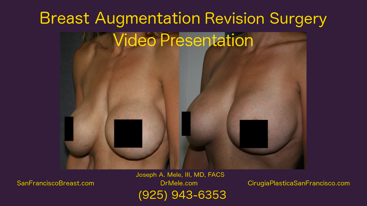 Breast Augmentation Revision before and after pictures of Breast Implant Revision