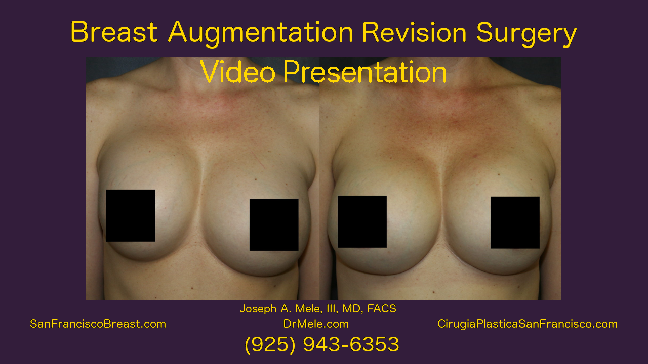 Breast Augmentation Revision before and after pictures of Breast Implant Revision