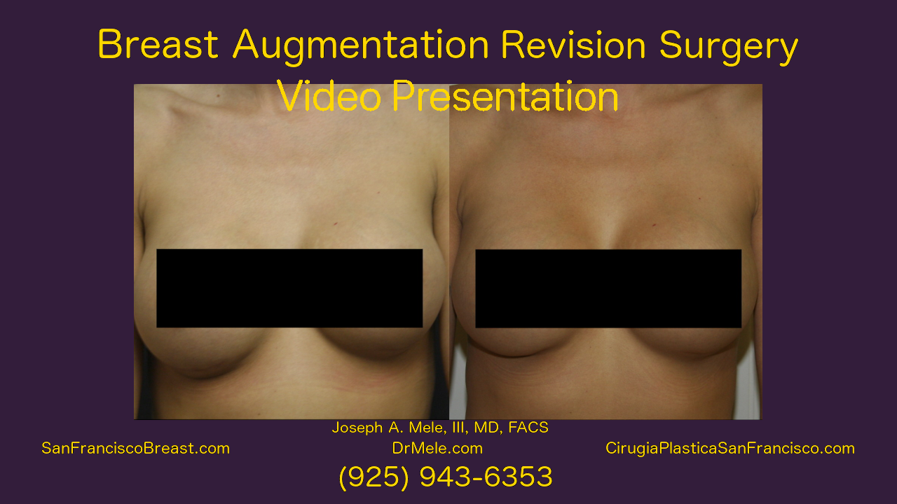 Breast Augmentation Revision before and after pictures of Breast Implant Revision