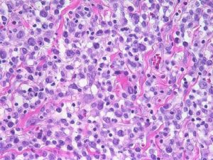 Breast Implant Associated Anaplastic Large Cell Lymphoma (BIA_ALCL)