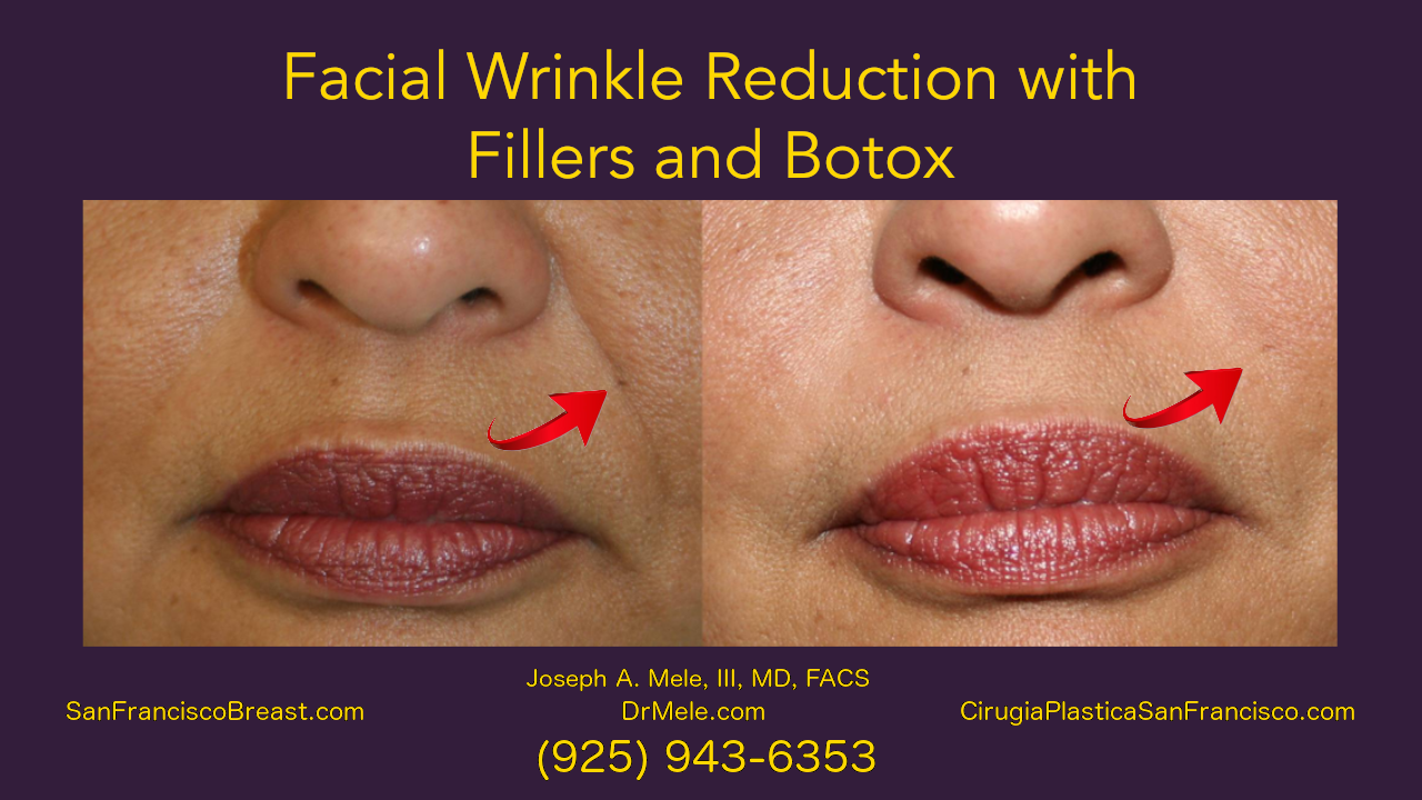 Facial Wrinkle Reduction Video with FIller and Botox before and after pictures