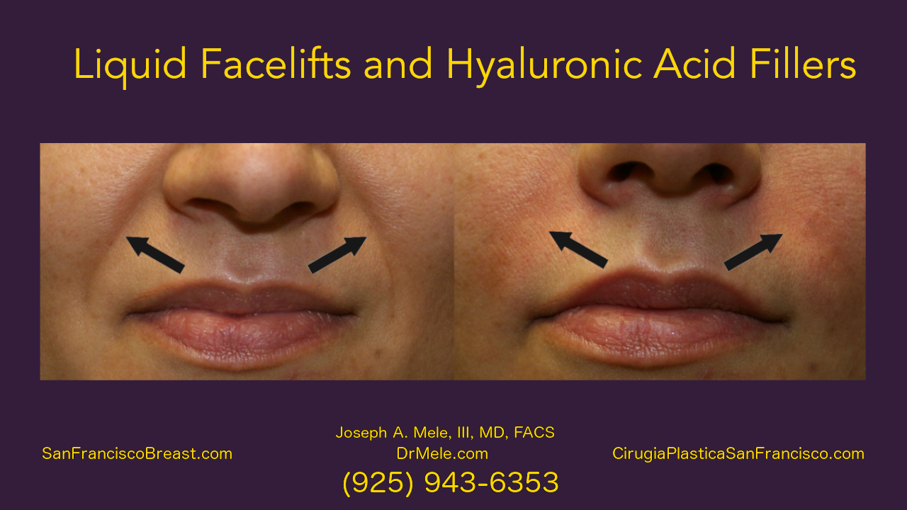 Liquid Facelifts Video and Hyaluronic Fillers before and after pictures