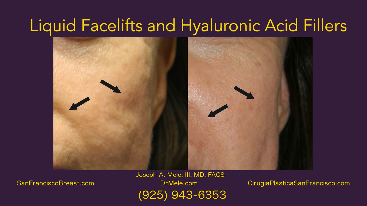 Liquid Facelifts Video and Hyaluronic Fillers before and after pictures