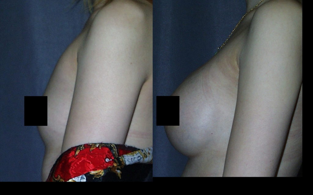 Submuscular Breast Augmentation with Smooth Round Breast Implants Submuscular Breast Augmentation with Smooth Round Breast Implants