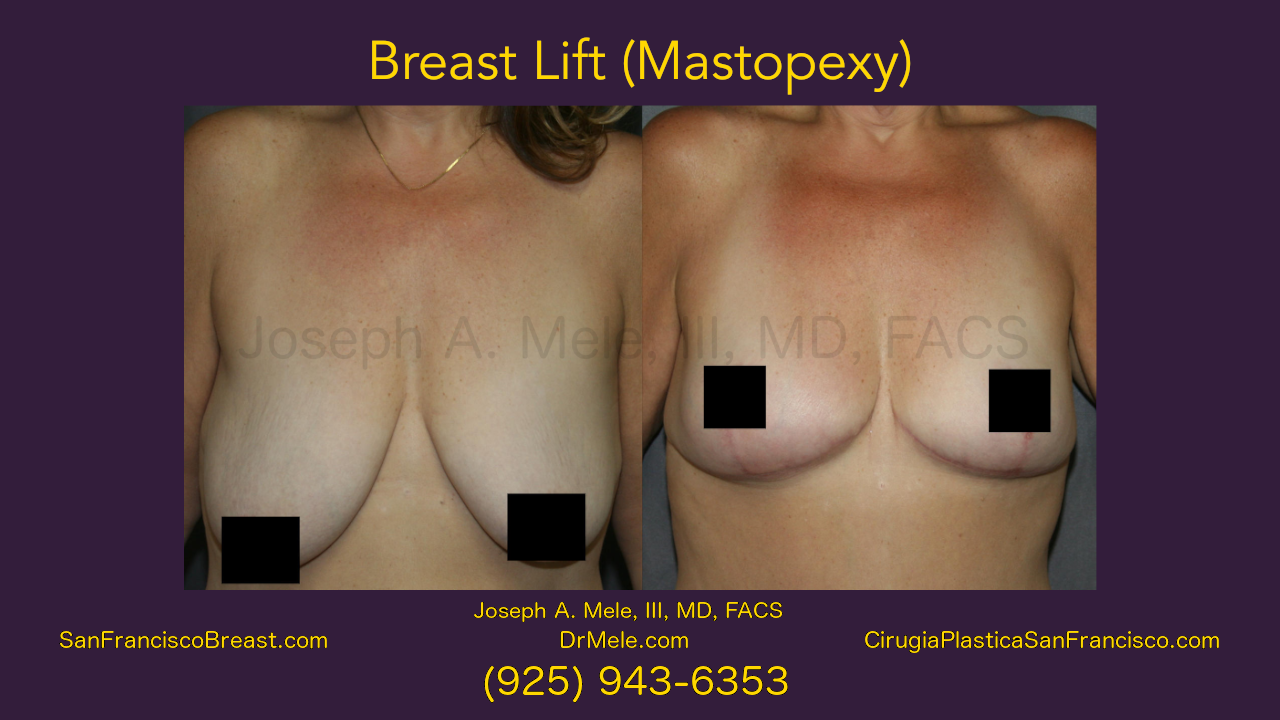Breast Lift Video (Mastopexy) before and after pictures