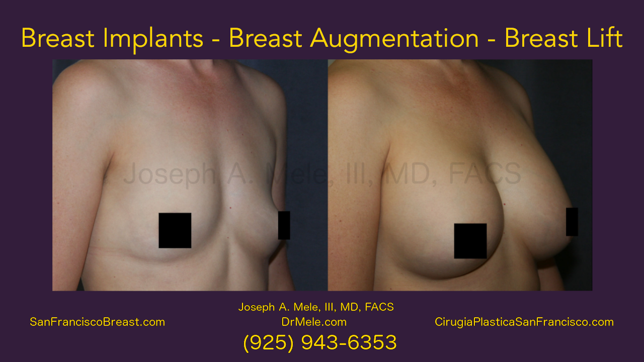 Breast Augmentation Breast Implants Breast Lift before and after pictures