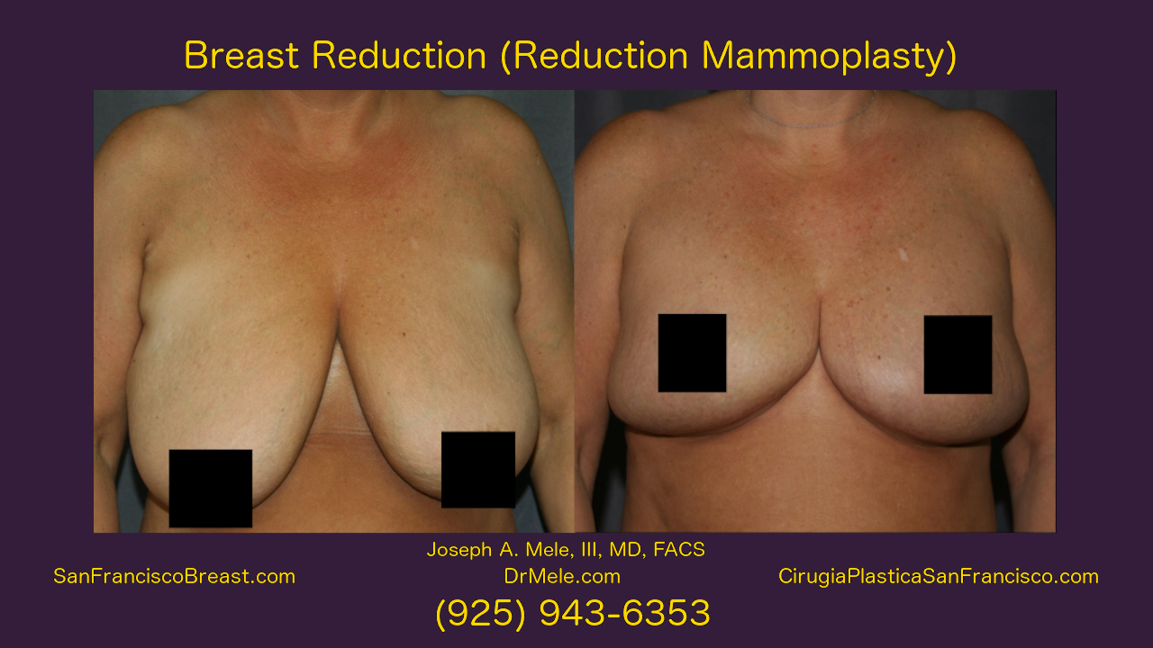 Breast Reduction Video Presentation with reduction mammoplasty before and after pictures