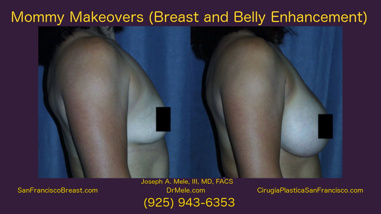 Mommy Makeover Video Presentation with Breast Augmentation and Tummy Tuck before and after pictures