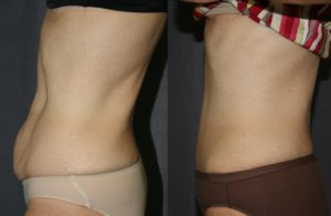 The before picture on the left shows no fat, a little loose skin and significantly loose muscle fascia giving that still a little pregnant look.
