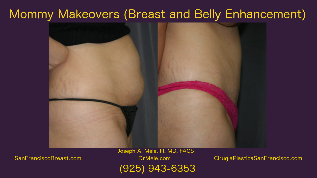 Mommy Makeover Video Presentation with Breast Augmentation and Tummy Tuck before and after pictures